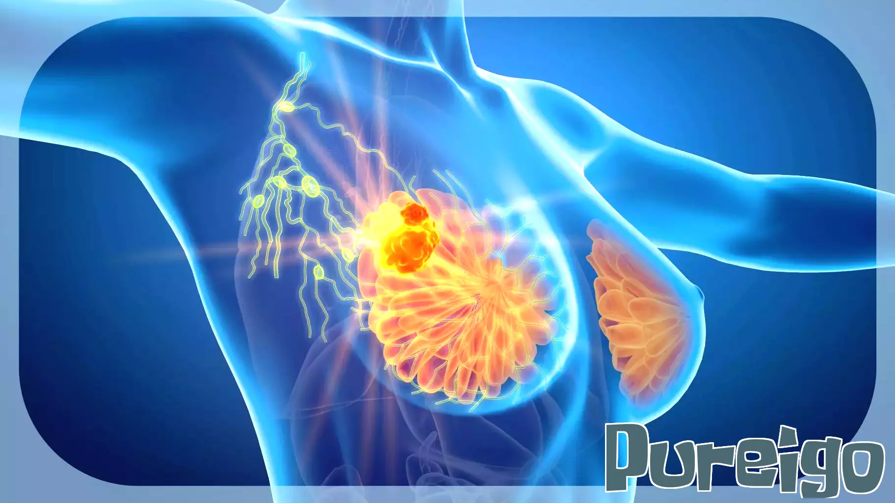 Canadian Approval for Adjuvant Ribociclib in Early Breast Cancer Treatment