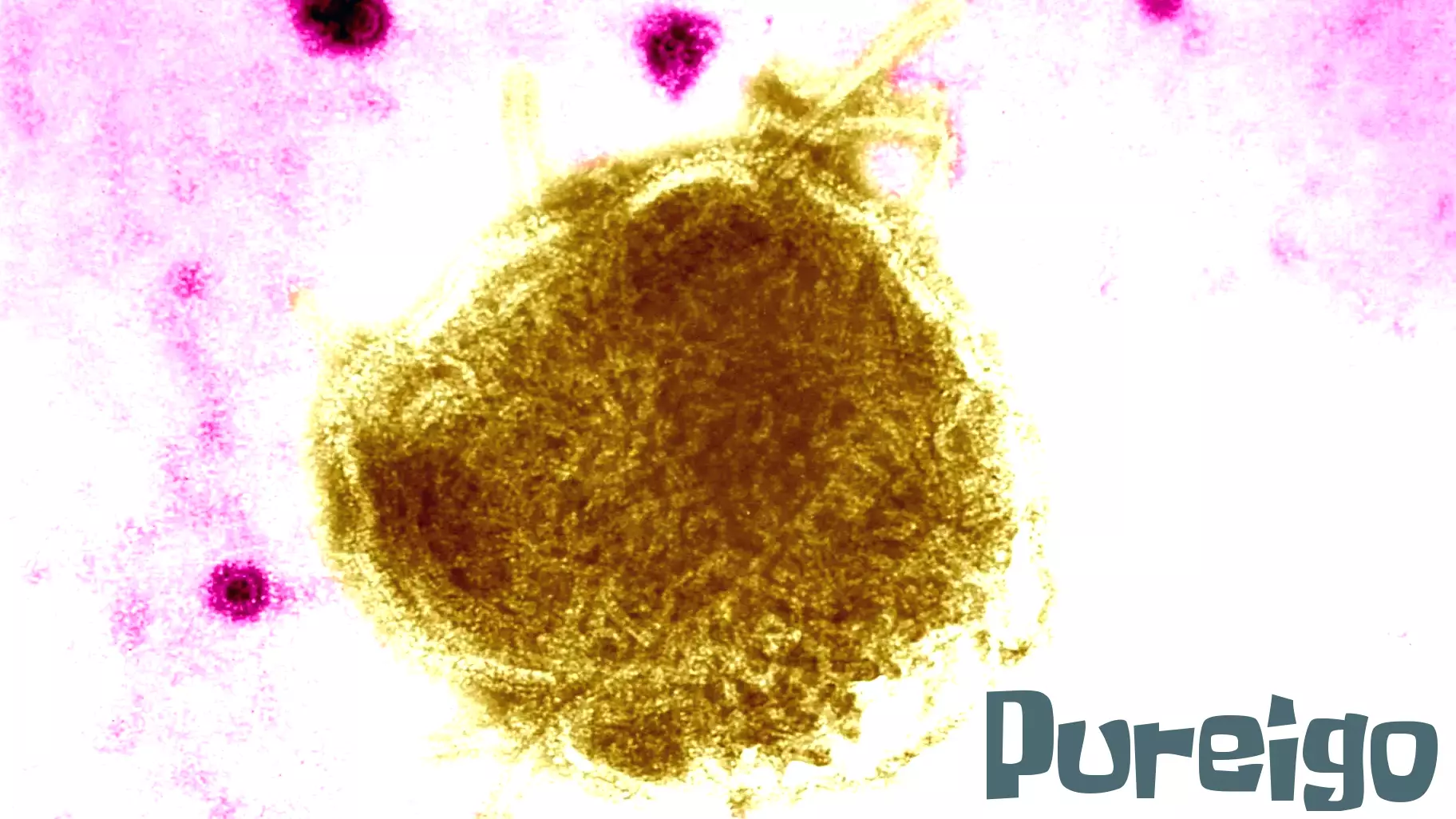 Placer County Public Health reports 3 confirmed measles cases, fourth suspected case