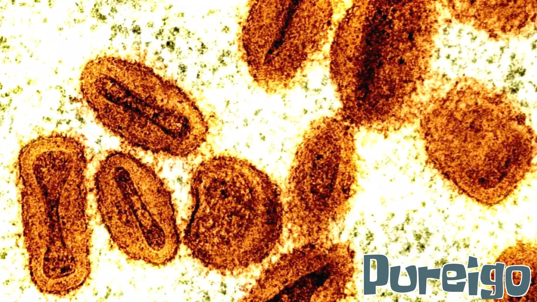 Rise in Mpox Cases in Massachusetts Raises Concerns