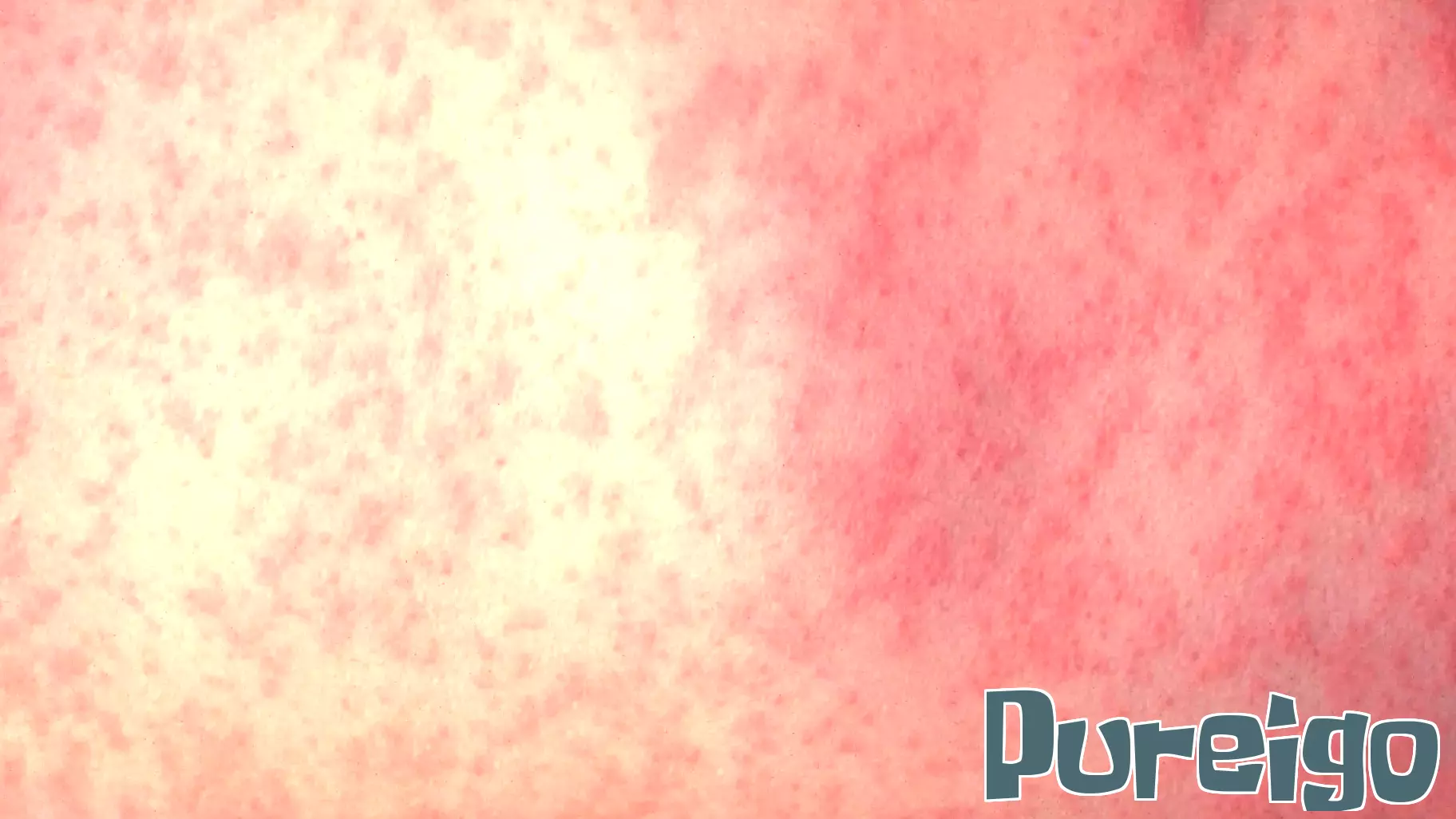 Virginia Reports Second Confirmed Case of Measles in a Teenager