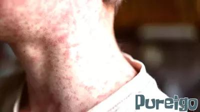 Measles Exposure Alert Issued in Grapevine by Tarrant County Public Health