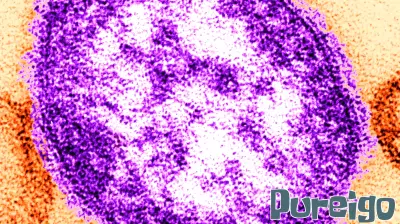 New Measles Case Reported in Bucks County Following Texas Trip