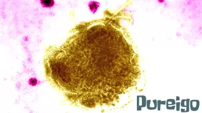 Placer County Public Health reports 3 confirmed measles cases, fourth suspected case