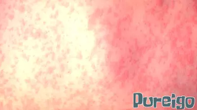 Virginia Reports Second Confirmed Case of Measles in a Teenager